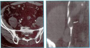 Transitional Cell Ca Ureter